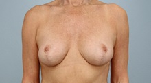 Brow Lift After Photo by Keith Neaman, MD; Salem, OR - Case 50448
