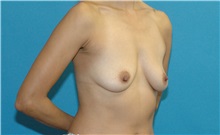 Breast Augmentation Before Photo by Scott Sattler, MD,  FACS; Seattle, WA - Case 50440