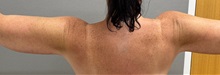 Arm Lift After Photo by Keshav Magge, MD; Bethesda, MD - Case 50501