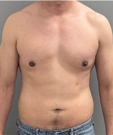 Male Breast Reduction After Photo by Keshav Magge, MD; Bethesda, MD - Case 50544