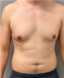 Male Breast Reduction Before Photo by Keshav Magge, MD; Bethesda, MD - Case 50544