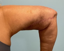 Liposuction After Photo by Julia Spears, MD, FACS; ,  - Case 50575
