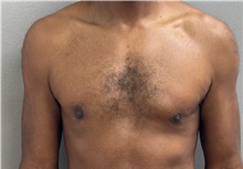 Male Breast Reduction After Photo by Keshav Magge, MD; Bethesda, MD - Case 50584