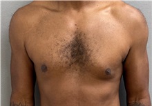 Male Breast Reduction Before Photo by Keshav Magge, MD; Bethesda, MD - Case 50584