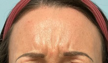 Botulinum Toxin Before Photo by Julia Spears, MD, FACS; ,  - Case 50779