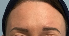 Botulinum Toxin After Photo by Julia Spears, MD, FACS; ,  - Case 50779