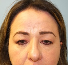 Brow Lift Before Photo by Lisa Brostrom, MD; San Antonio, TX - Case 49922