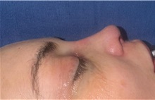 Rhinoplasty After Photo by Mark Markarian, MD, MSPH, FACS; Wellesley, MA - Case 49951