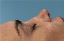 Rhinoplasty Before Photo by Mark Markarian, MD, MSPH, FACS; Wellesley, MA - Case 49951