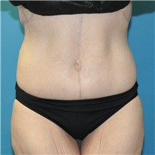 Body Lift After Photo by Joshua Cooper, MD; Seattle, WA - Case 50083