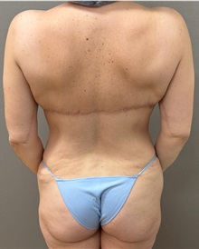 Body Contouring After Photo by Keshav Magge, MD; Bethesda, MD - Case 50202