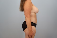 Mommy Makeover After Photo by Keith Neaman, MD; Salem, OR - Case 50241