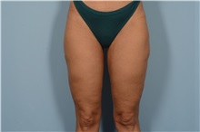Thigh Lift After Photo by Ellen Janetzke, MD; ,  - Case 49316