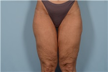 Thigh Lift Before Photo by Ellen Janetzke, MD; ,  - Case 49316