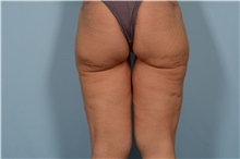 Thigh Lift Before Photo by Ellen Janetzke, MD; ,  - Case 49316