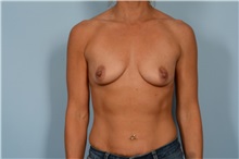 Breast Augmentation Before Photo by Ellen Janetzke, MD; ,  - Case 49302