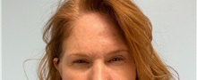 Botulinum Toxin After Photo by Julia Spears, MD, FACS; ,  - Case 49308