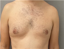Male Breast Reduction Before Photo by Keshav Magge, MD; Bethesda, MD - Case 49406