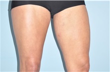 Thigh Lift After Photo by Keyian Paydar, MD, FACS; Newport Beach, CA - Case 49601