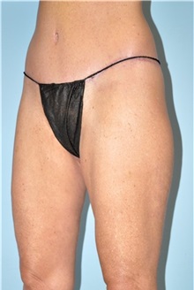 Thigh Lift After Photo by Keyian Paydar, MD, FACS; Newport Beach, CA - Case 49600