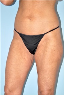 Thigh Lift Before Photo by Keyian Paydar, MD, FACS; Newport Beach, CA - Case 49600