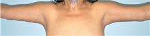 Arm Lift After Photo by Keyian Paydar, MD, FACS; Newport Beach, CA - Case 49603