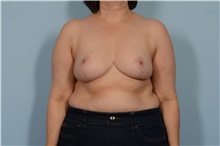 Breast Reduction After Photo by Ellen Janetzke, MD; ,  - Case 49616