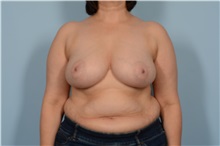 Breast Reduction Before Photo by Ellen Janetzke, MD; ,  - Case 49616