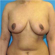 Breast Reduction After Photo by Joshua Cooper, MD; Seattle, WA - Case 49656