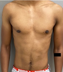 Male Breast Reduction After Photo by Keshav Magge, MD; Bethesda, MD - Case 49658