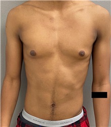 Male Breast Reduction Before Photo by Keshav Magge, MD; Bethesda, MD - Case 49658