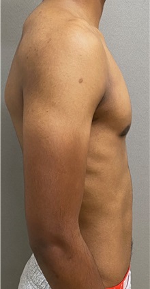 Male Breast Reduction After Photo by Keshav Magge, MD; Bethesda, MD - Case 49658