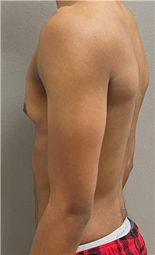 Male Breast Reduction Before Photo by Keshav Magge, MD; Bethesda, MD - Case 49658