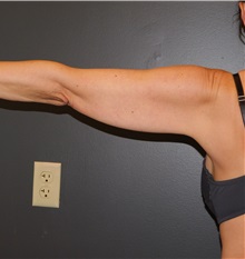 Arm Lift Before Photo by Michele DeVito, MD, FACS; Scottsdale, AZ - Case 49665