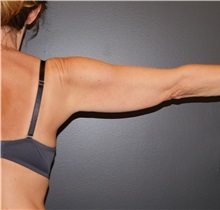 Arm Lift Before Photo by Michele DeVito, MD, FACS; Scottsdale, AZ - Case 49665