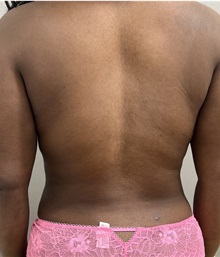 Liposuction After Photo by Franklin Richards, MD; ,  - Case 49698