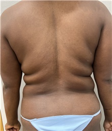 Liposuction Before Photo by Franklin Richards, MD; ,  - Case 49698