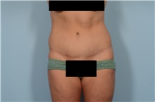 Tummy Tuck After Photo by Ellen Janetzke, MD; ,  - Case 49829