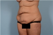 Tummy Tuck Before Photo by Ellen Janetzke, MD; ,  - Case 49829