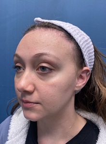 Brow Lift After Photo by Lisa Brostrom, MD; San Antonio, TX - Case 49850