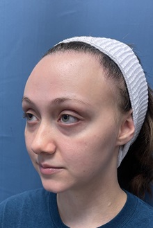 Brow Lift Before Photo by Lisa Brostrom, MD; San Antonio, TX - Case 49850