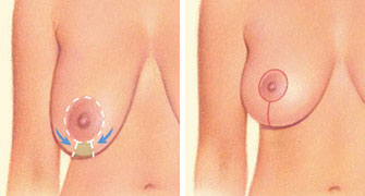 Breast lift incision vertical Breast lift incision vertical