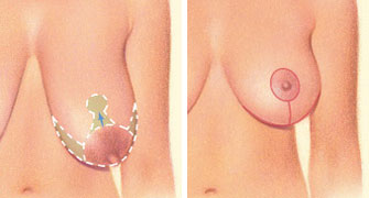 Breast lift incision horizontal Breast lift incision horizontal