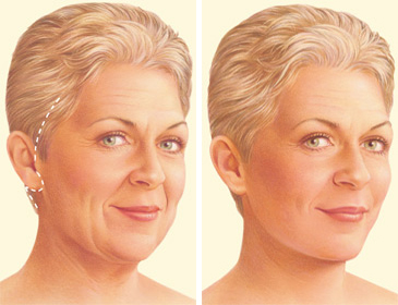 facelift traditional incision facelift traditional incision