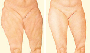 Medial thigh lift incision Medial thigh lift incision