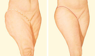 Outer thigh lift incision Outer thigh lift incision