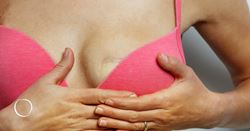 What is "SWIM" breast reconstruction?