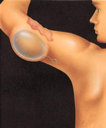 Tissue expansion Tissue expansion
